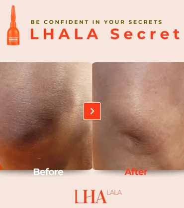 LHALA Peel cosmetic outcome image 2