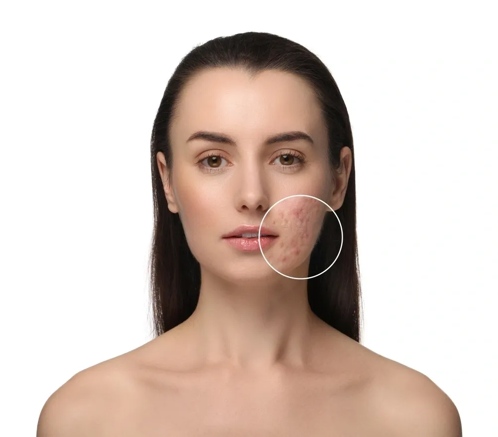 Acne Treatment Brisbane